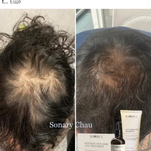Clients results anti hair loss shampoo autrodhea 2