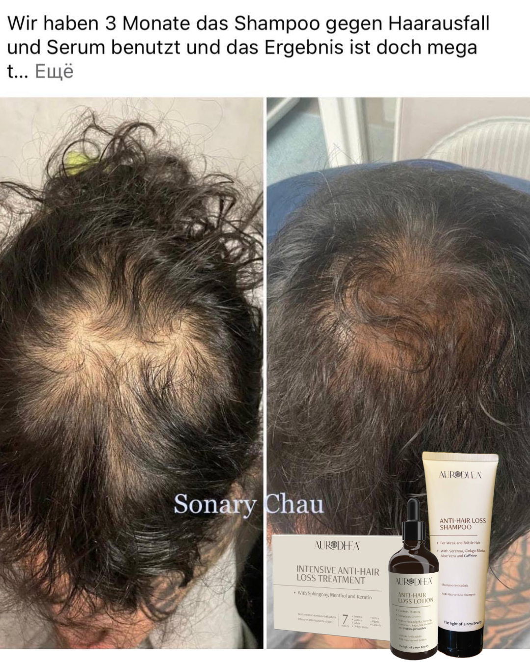 Clients results anti hair loss shampoo autrodhea 2