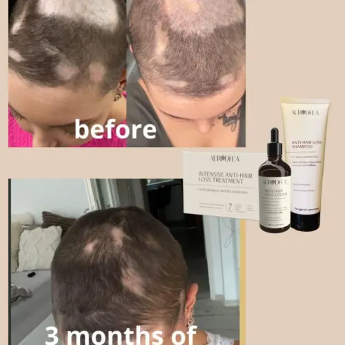 Clients results anti hair loss shampoo autrodhea 2