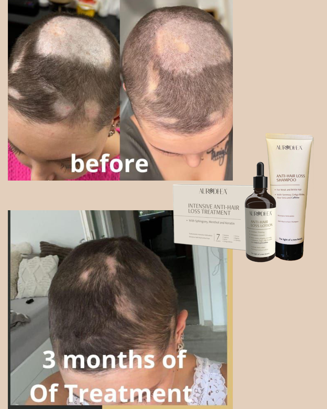 Clients results anti hair loss shampoo autrodhea 2
